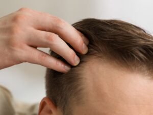 Como Saber se Sua Queda de Cabelo E Normal ou Preocupante