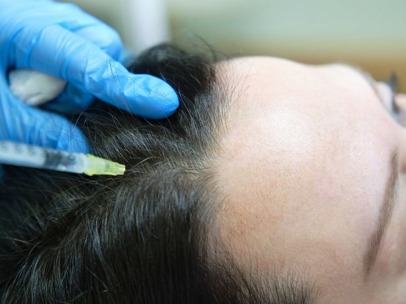 Intradermoterapia Capilar em Curitiba