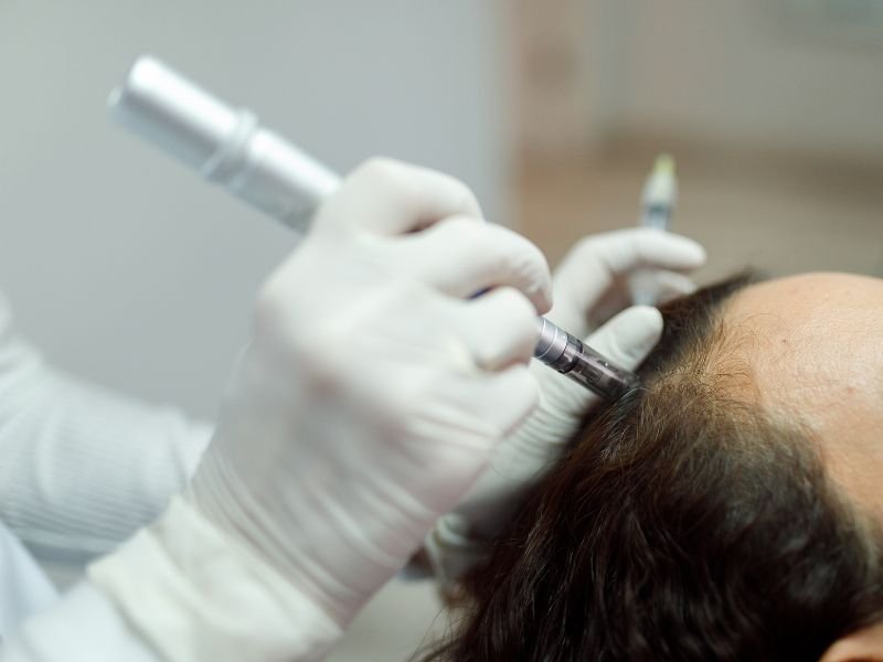 Microagulhamento Capilar com Drug Delivery curitiba