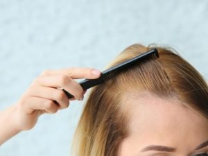 Alopecia feminina em Curitiba