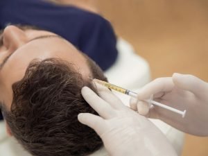 Alopecia masculina com especialista em Curitiba