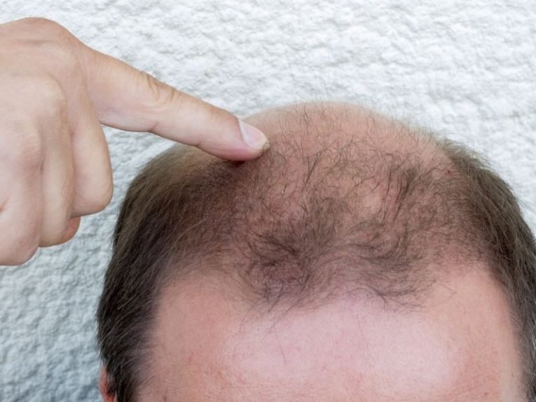 Clínica de alopecia areata em Curitiba
