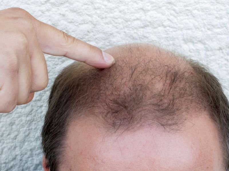 Clínica de alopecia areata em Curitiba