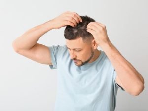 Alopecia frontal fibrosante em Curitiba