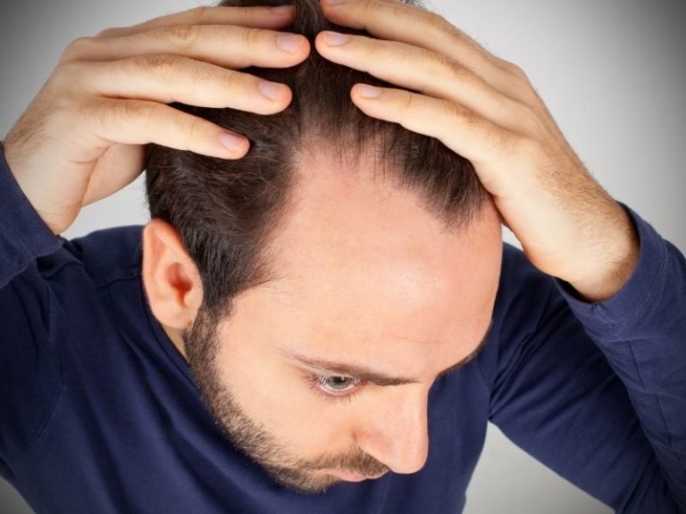 Alopecia frontal fibrosante com especialista em Curitiba