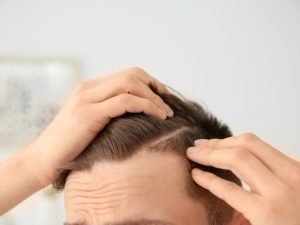 Alopecia por tração em Curitiba