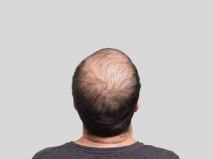 Calvície hereditária em Curitiba