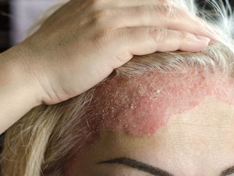 Dermatite seborreica em Curitiba