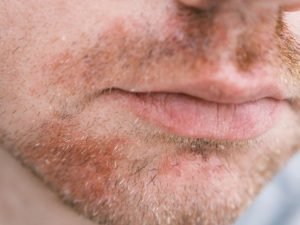 Tratamento de dermatite seborreica em Curitiba