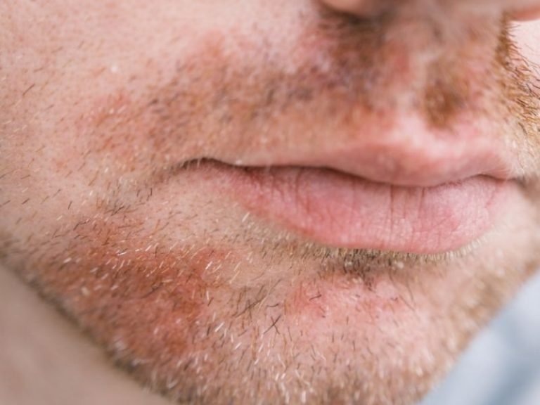 Tratamento de dermatite seborreica em Curitiba