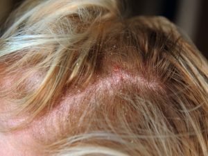 Dermatite seborreica com especialista em Curitiba