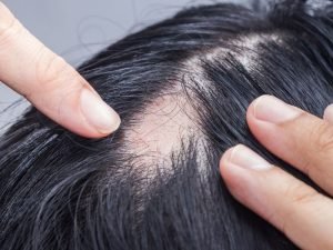 Clínica que trata alopecia em Curitiba