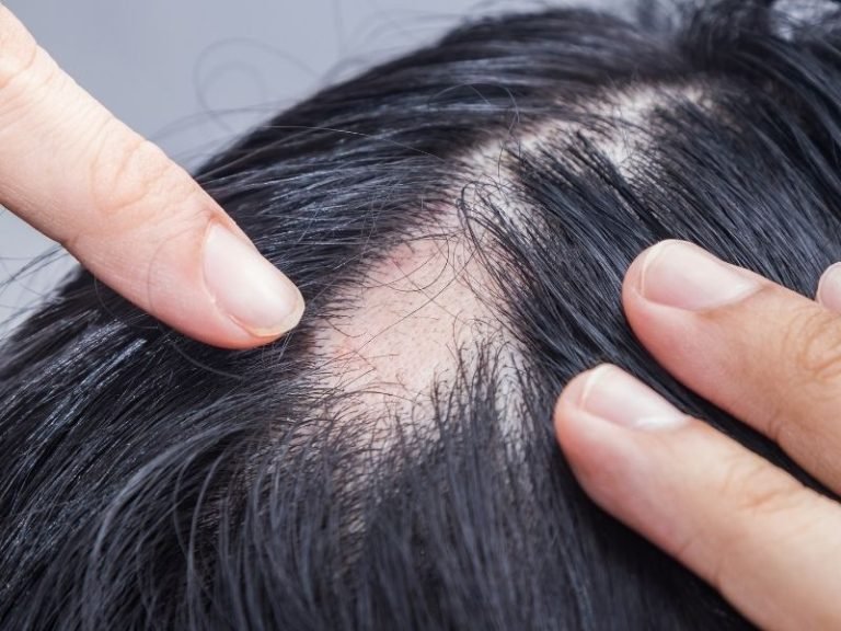 Clínica que trata alopecia em Curitiba