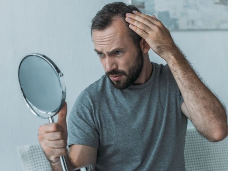 Terapia capilar em homens com calvície em Curitiba