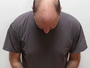 Tricologista em Curitiba: Boqueirão