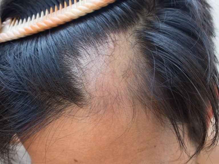Tratamento de pós-covid queda de cabelo em Curitiba