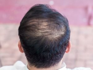 Pós-COVID queda de cabelo com especialista em Curitiba