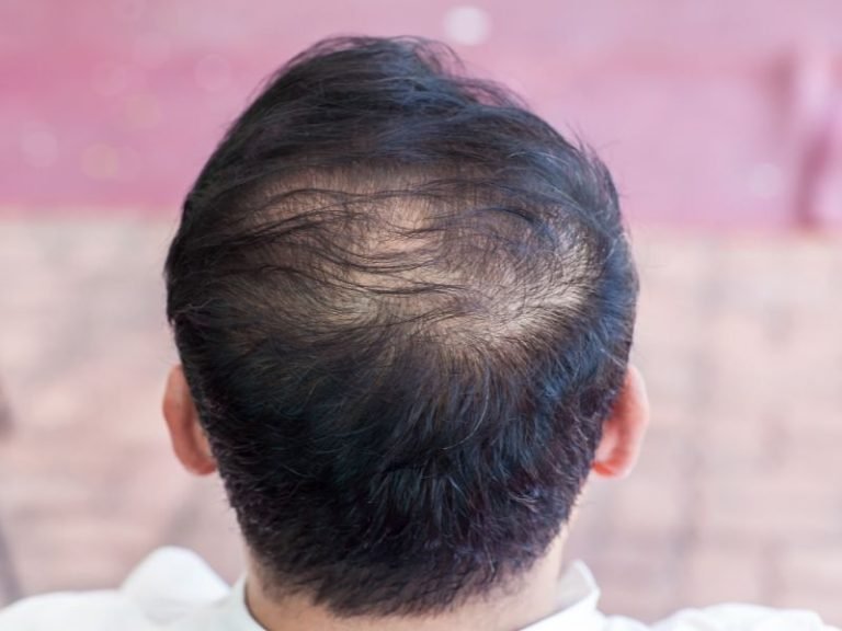 Pós-COVID queda de cabelo com especialista em Curitiba