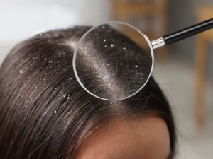 Tratamento para caspa em Curitiba