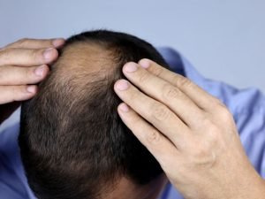 Clínica de tratamento para calvície em Curitiba