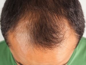 Tricologista para calvície em Curitiba