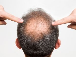 Tricologista para homens em Curitiba
