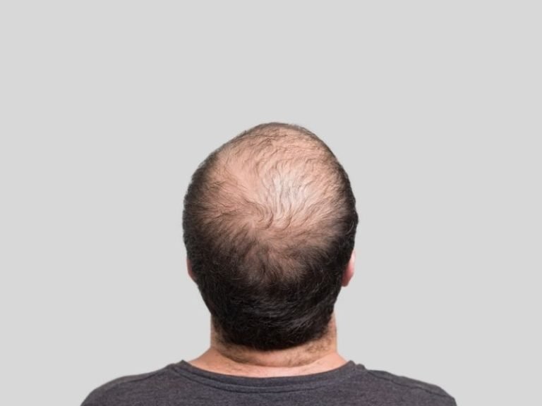 Especialista em calvície masculina em Curitiba