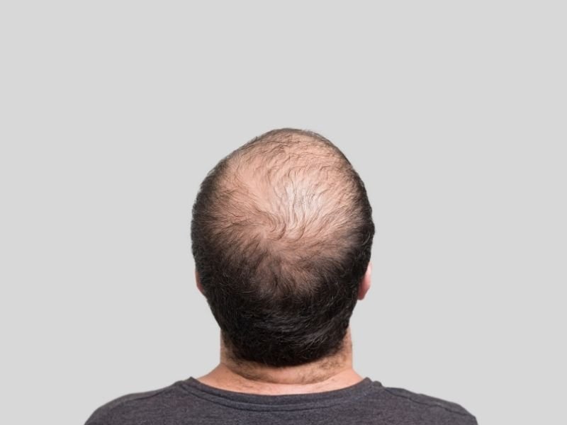 Especialista em calvície masculina em Curitiba