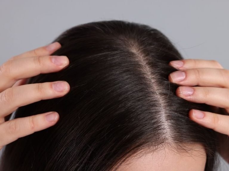 Especialista em alopecia areata em Curitiba
