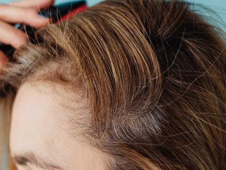Especialista em alopecia frontal fibrosante em Curitiba