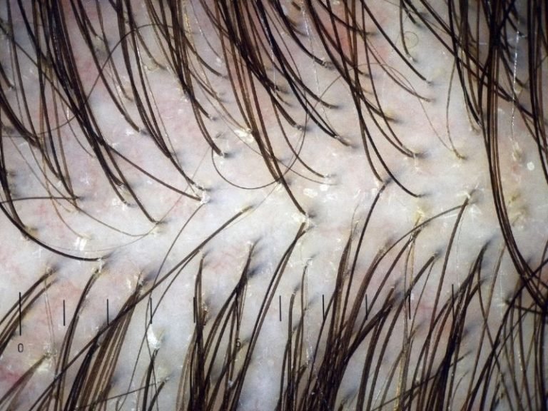 Especialista em LEDterapia capilar em Curitiba