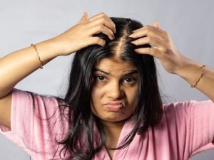 Alopecia androgenética com especialista em Curitiba